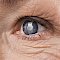 Close up of the eye of an elderly person with glaucoma
