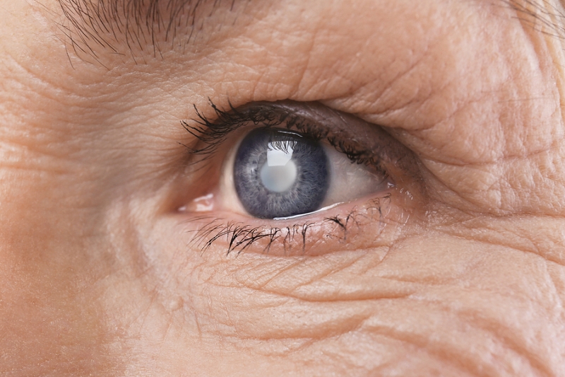 Close up of the eye of an elderly person with glaucoma